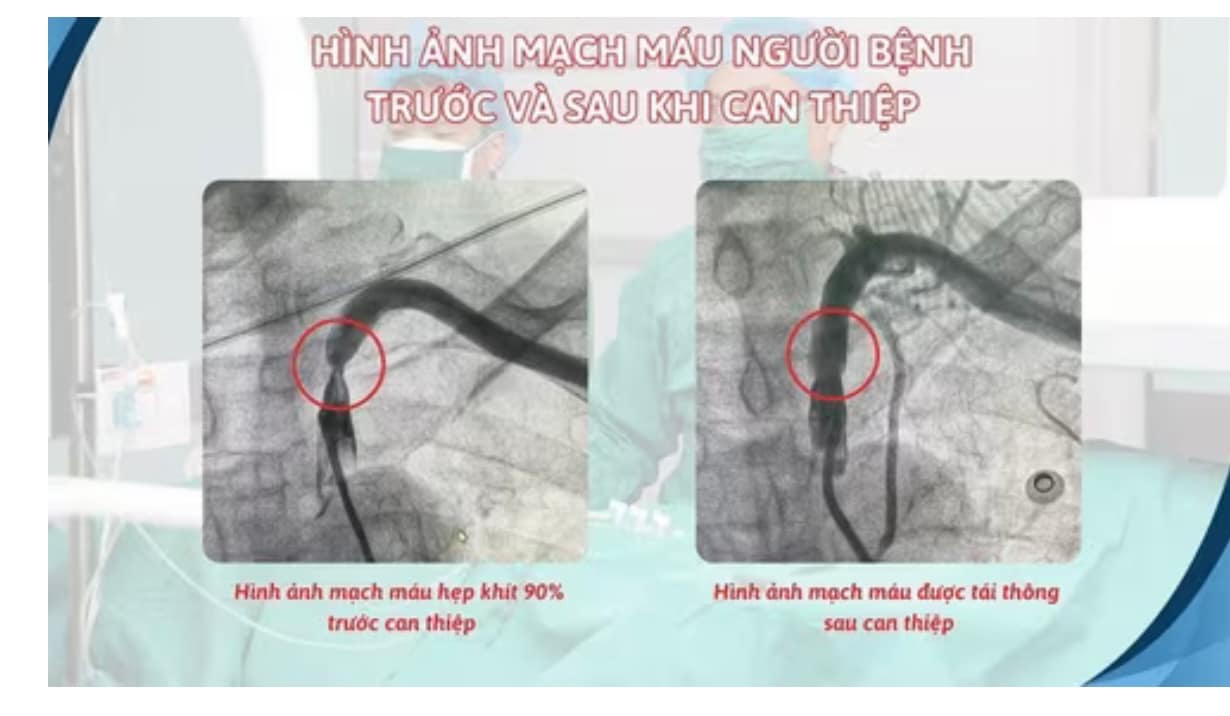 🧠 Đột quỵ từ hội chứng “ăn cắp máu” động mạch dưới đòn